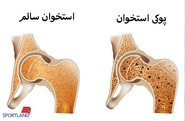 ورزش-برای-درمان-پوکی-استخوان